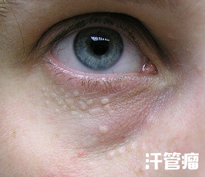 40岁眼周适合用什么样的眼霜,眼周发黑适合用什么眼霜