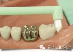 蛀牙怎么才能清洗干净牙科,自己怎么清理牙上的蛀牙