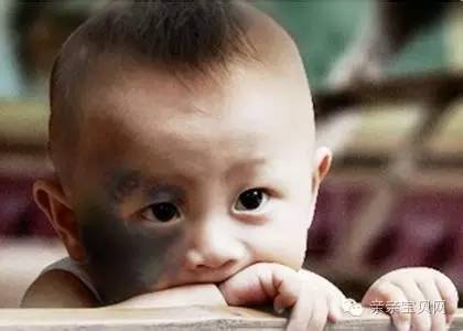 红痣与黑痣对人体健康的影响,红痣竟是健康信号灯