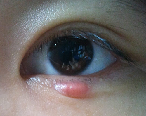 眼皮肿了有个小疙瘩怎么回事,针眼会引起眼皮肿吗