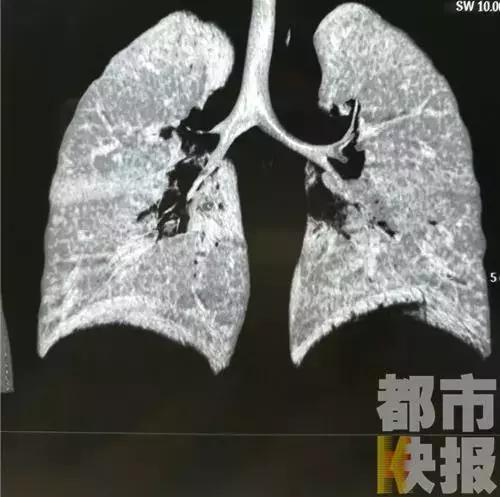 吃螃蟹要注意！商洛4岁男孩吃完它肺里竟出现这个