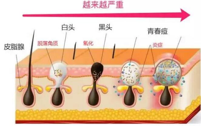毛孔粗大黑头痘痘适合哪种护肤品,毛孔粗大黑头痘痘修复烂脸精华液