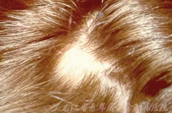 皮肤病的饮食注意哪些,常见皮肤病食疗