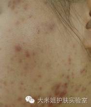 揭秘快速美白祛斑套路,美白祛斑原理