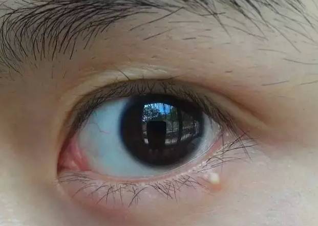 眼睛周围有白色的小点是不是疣,眼睛下边有白点不是脂肪粒是什么