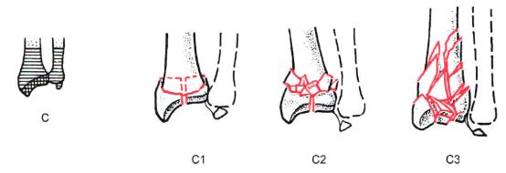 桡骨远端骨折传统石膏打法,成人桡骨远端骨折诊疗指南2023版