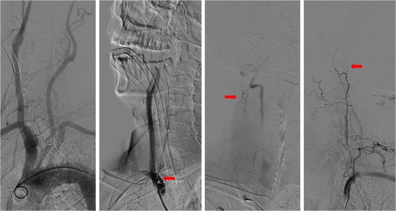 后循环系统梗死,后循环梗死
