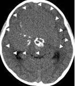 周忠清颅咽管瘤全切的终身复发率,周忠清谈颅咽管瘤术后寿命