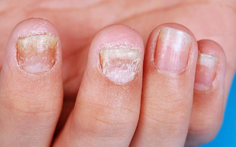 指甲变脆是缺维生素吗,指甲变弯缺什么微量元素