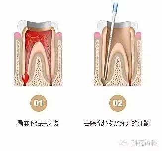 抽牙神经根管治疗过程,抽神经的症状和危害