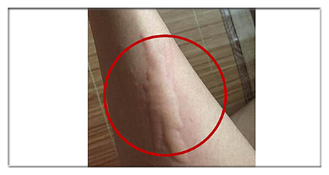 皮肤红肿瘙痒还有灼热感后起水泡,皮肤突然红肿发热瘙痒是怎么回事