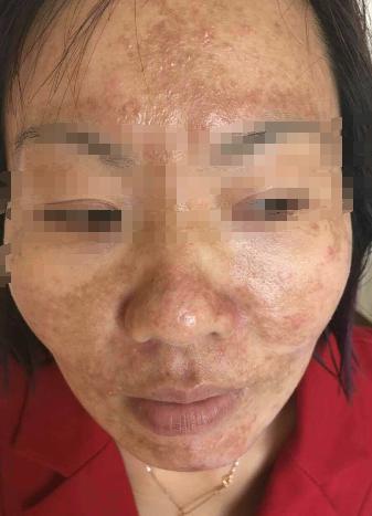 花了三万治疗*褐斑黄**不满美容效果女子提出巨额索赔