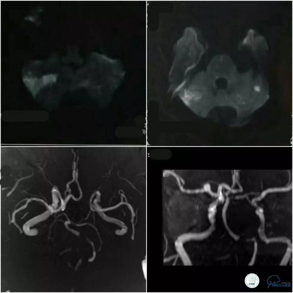 天坛周记|左椎V4段-基底动脉交界区狭窄的支架治疗
