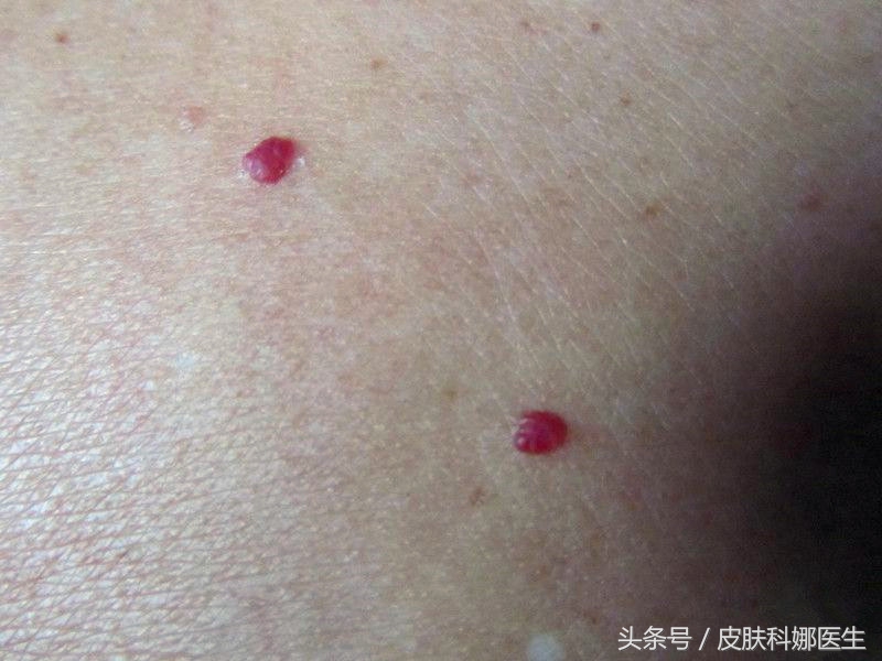 皮肤上有一细小点红痣是代表什么,脸上长的红痣能用药点吗