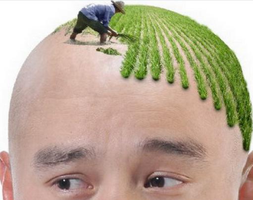 头顶脱发四指深算几级脱发,额头不脱发但头顶上脱发怎么回事