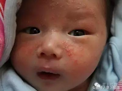 她年年吃螃蟹都没事，今年吃却满身长紫斑还尿血！为啥？