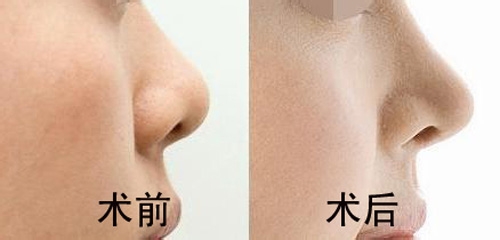 隆鼻多长时间可以恢复,隆鼻恢复过程记录图片