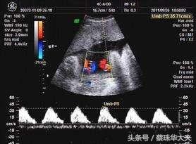 怀孕26周脐血流sd4.2正常吗,33周胎儿脐血流sd值偏高怎么办