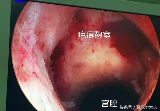 孕13周胎盘覆盖宫内口,13周下缘达宫颈内口危险吗