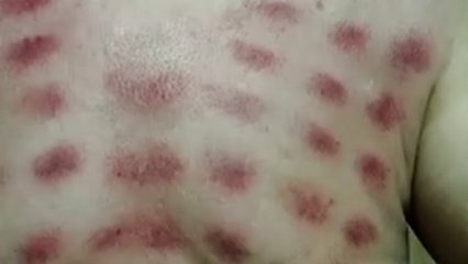 只需学会这几招在家也能刮痧,刮痧学会自己刮