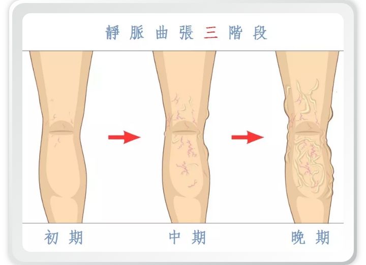 预防静脉曲张的关键就是了解病因,精索静脉曲张的原因