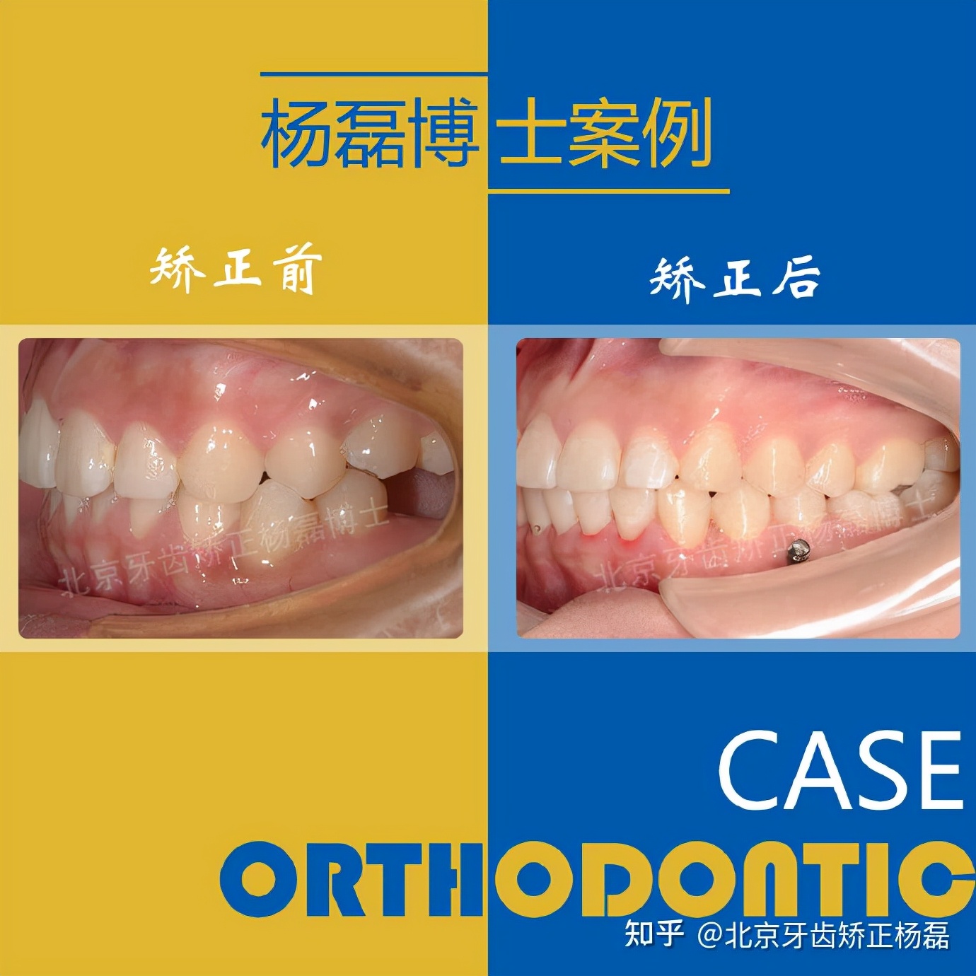 整牙半隐形牙套,缺牙可以用隐形牙套矫正的全过程