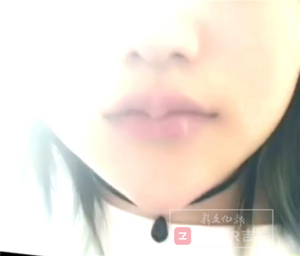 为变美做整容手术,女孩为变美注射玻尿酸