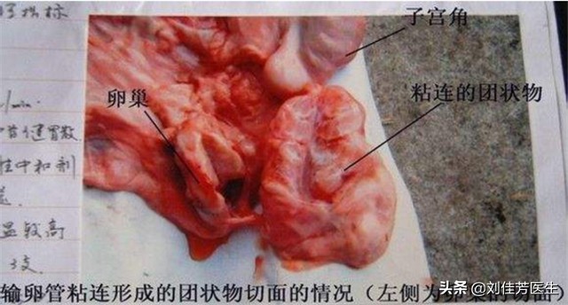 输卵管堵塞最有效的疏通方法,输卵管堵塞疏通妙招