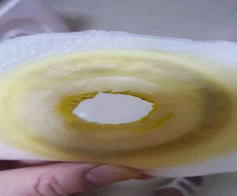 造口凹陷回缩护理视频,造口回纳术后的护理方法