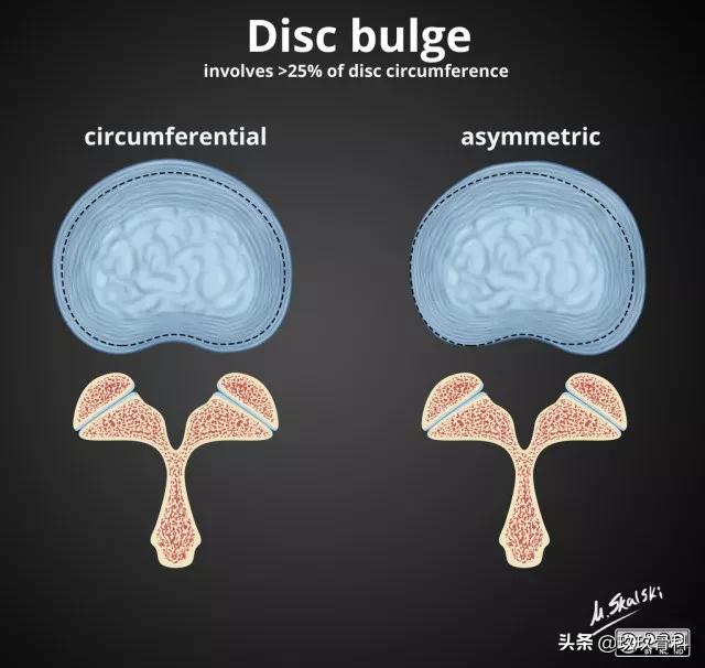 图解：椎间盘膨出、突出、脱出