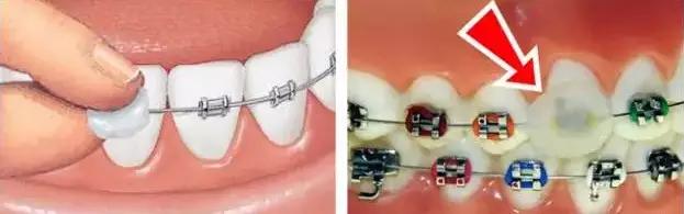 矫正牙齿是如何戴牙套的,矫正牙齿戴牙套需要注意事项