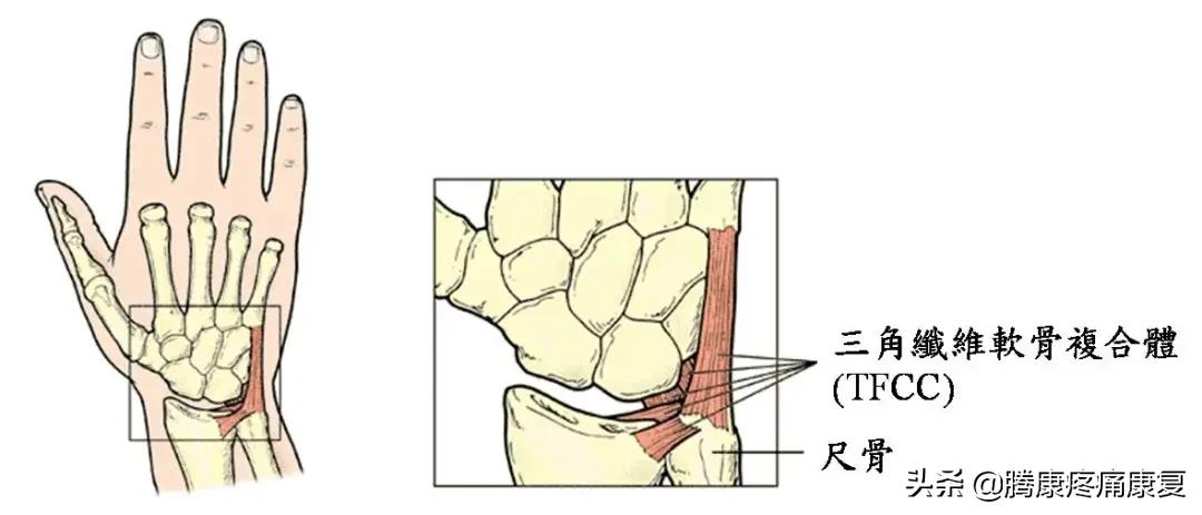 腕关节三角纤维软骨复合体损伤,三角纤维软骨损伤最佳治疗方法