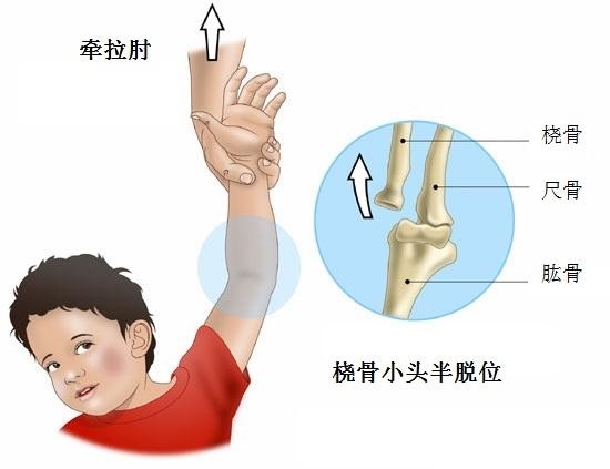 胳膊容易掉环是怎么回事,大人胳膊掉环了怎么办