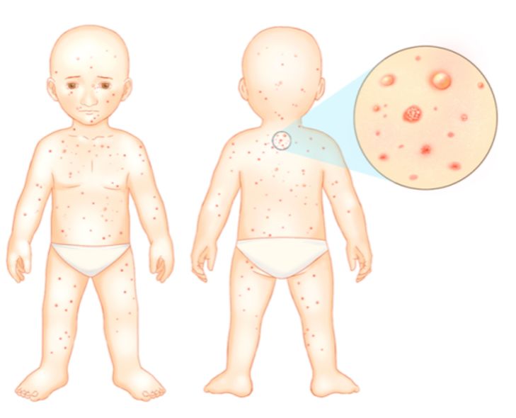 孕早期长了一小部分水痘怎么办,妊娠期起水痘了怎么办