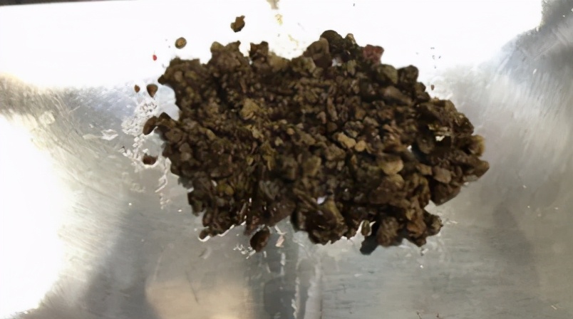 结石多大可以做体外冲击波碎石,男子排石失败肾结石堵输尿管