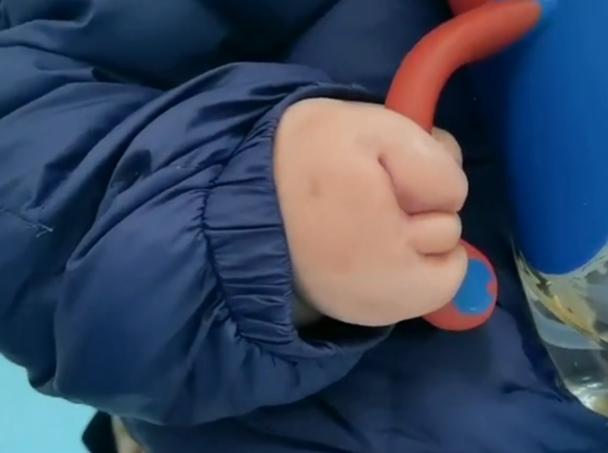 并指畸形免植皮案例,并指畸形