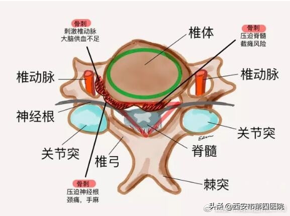 骨头里长刺严重吗,骨头长刺怎么治疗好得快