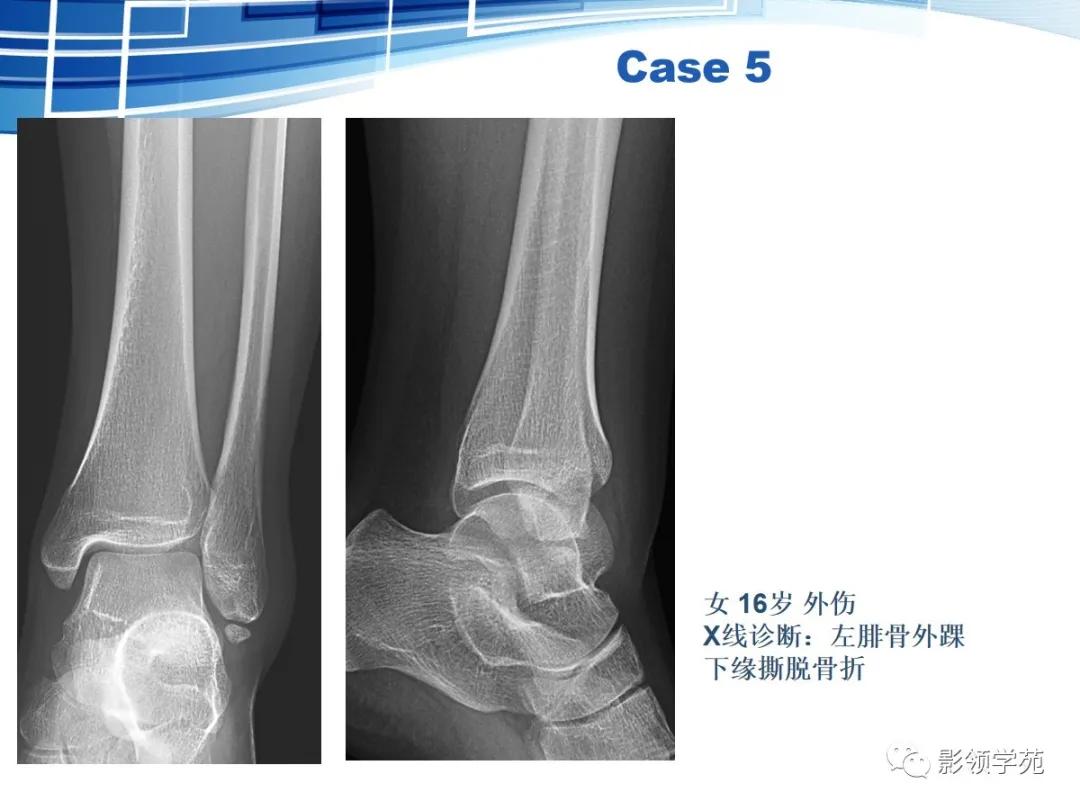 桡骨远端骨折引起尺骨变异,撕脱骨折一个月无明显骨痂形成