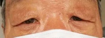 眼整形修复权威科普,科普眼整形手术是个什么手术多图