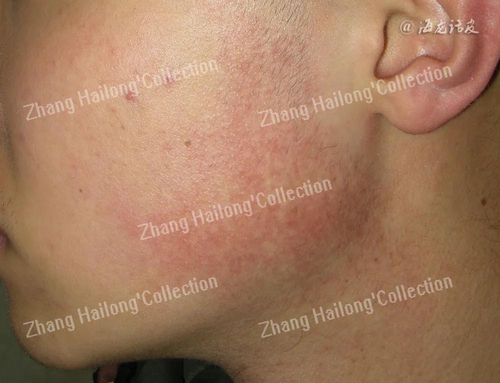 阿达帕林能治痤疮吗,托法替布在皮肤科的应用