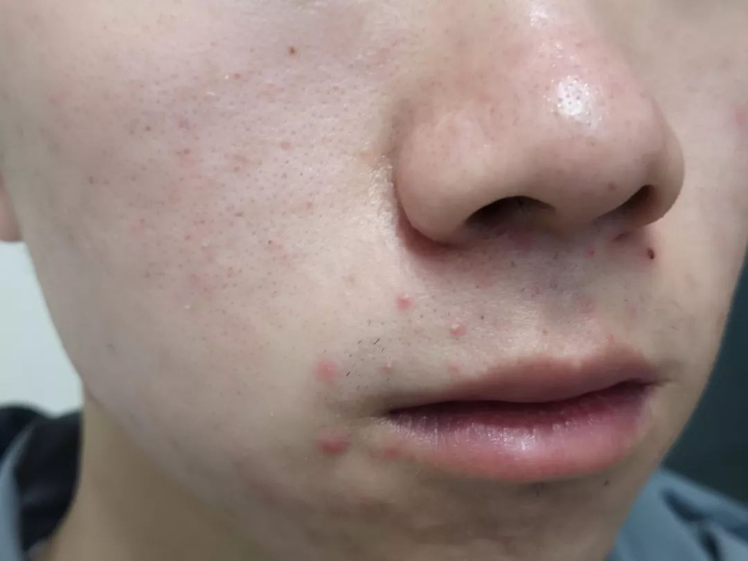 皮肤科医生最喜欢的痘痘