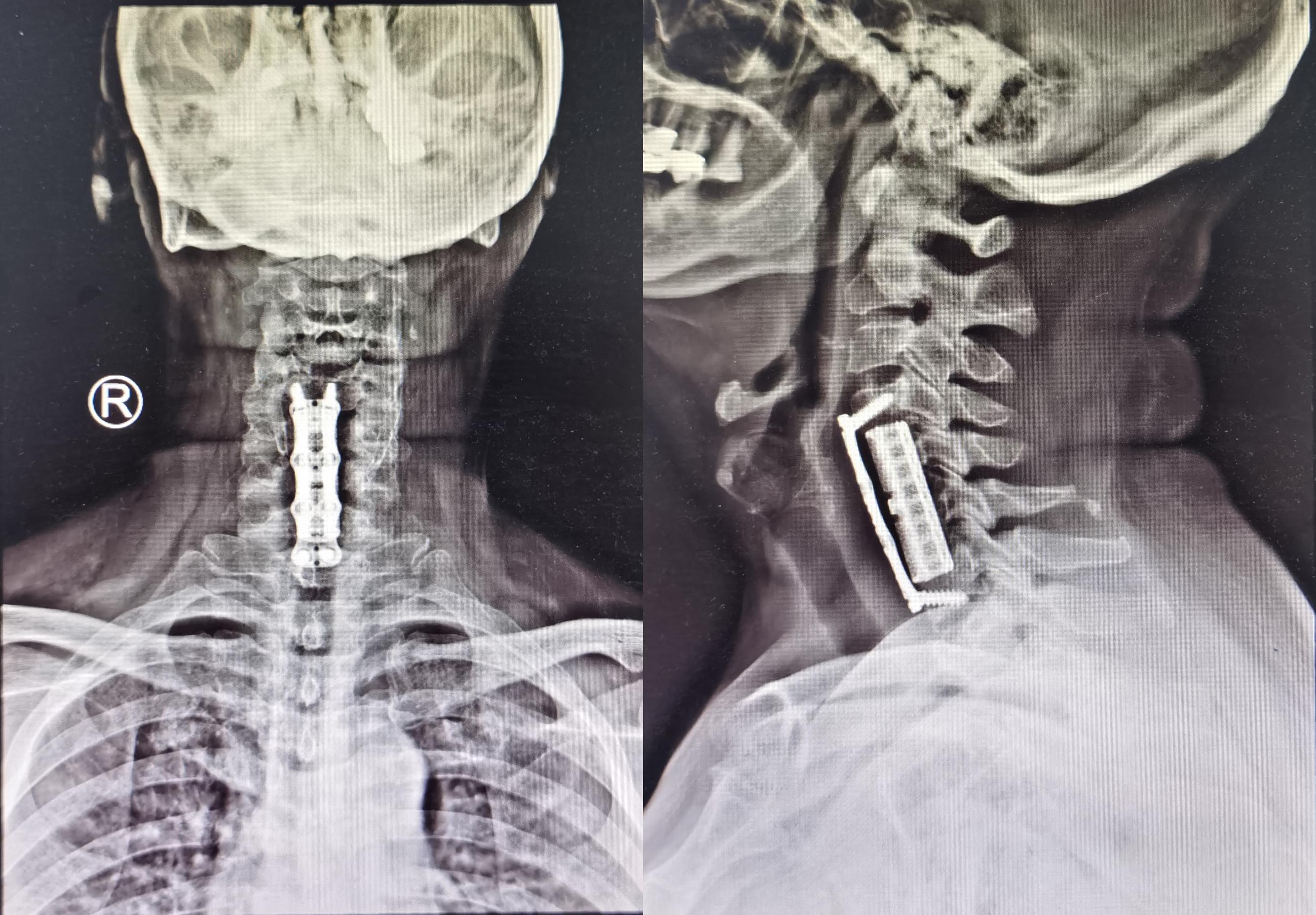 颈椎术后脑脊液漏取什么体位,脊髓型颈椎病手术后植骨愈合时间