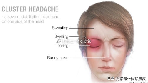 运动性头痛治疗,运动治愈偏头痛