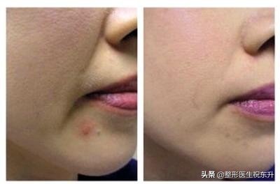 去除法令纹的最有效的方法是什么,去除法令纹最有效的方法是什么