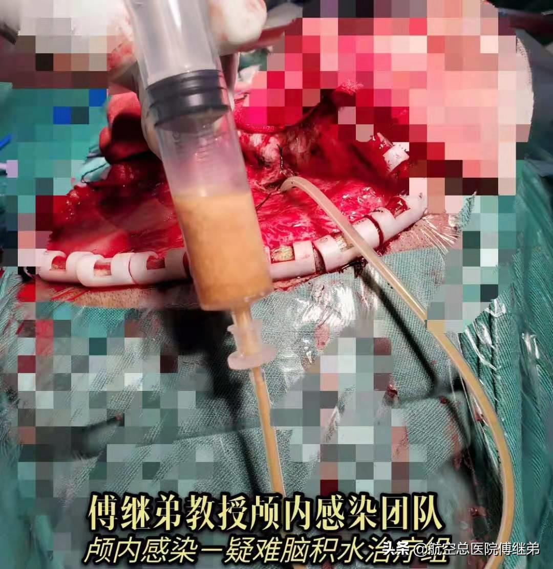鲍曼不动杆菌多重耐药血液感染,鲍曼不动杆菌感染死亡率