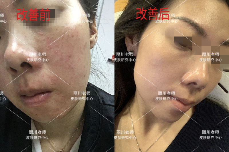 兰亭护肤品能治疗激素脸吗,兰亭化妆品嫩白祛斑霜