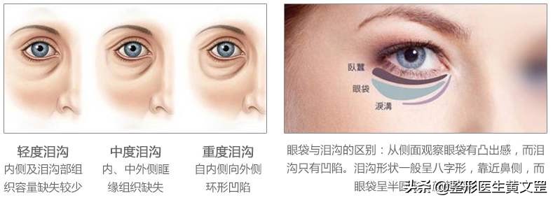 有了泪沟怎么消除,改善显老泪沟试试这3种方法