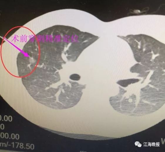 只因体检多做了这一项…26岁小伙捡回一条命
