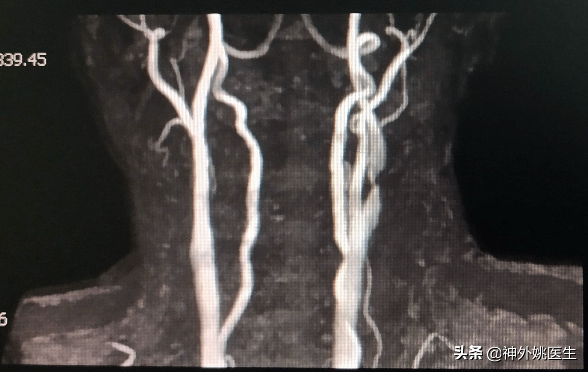 颈内动脉狭窄内膜剥脱术风险大吗,颈动脉内膜摘除手术