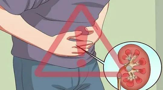 肾结石的前世今生,科普一下肾结石